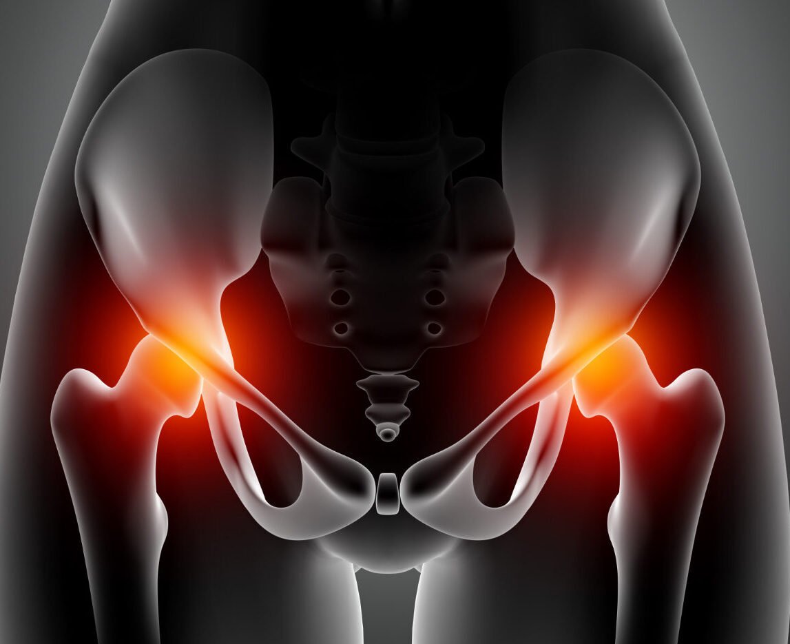 ολική αρθροπλαστική ισχίου