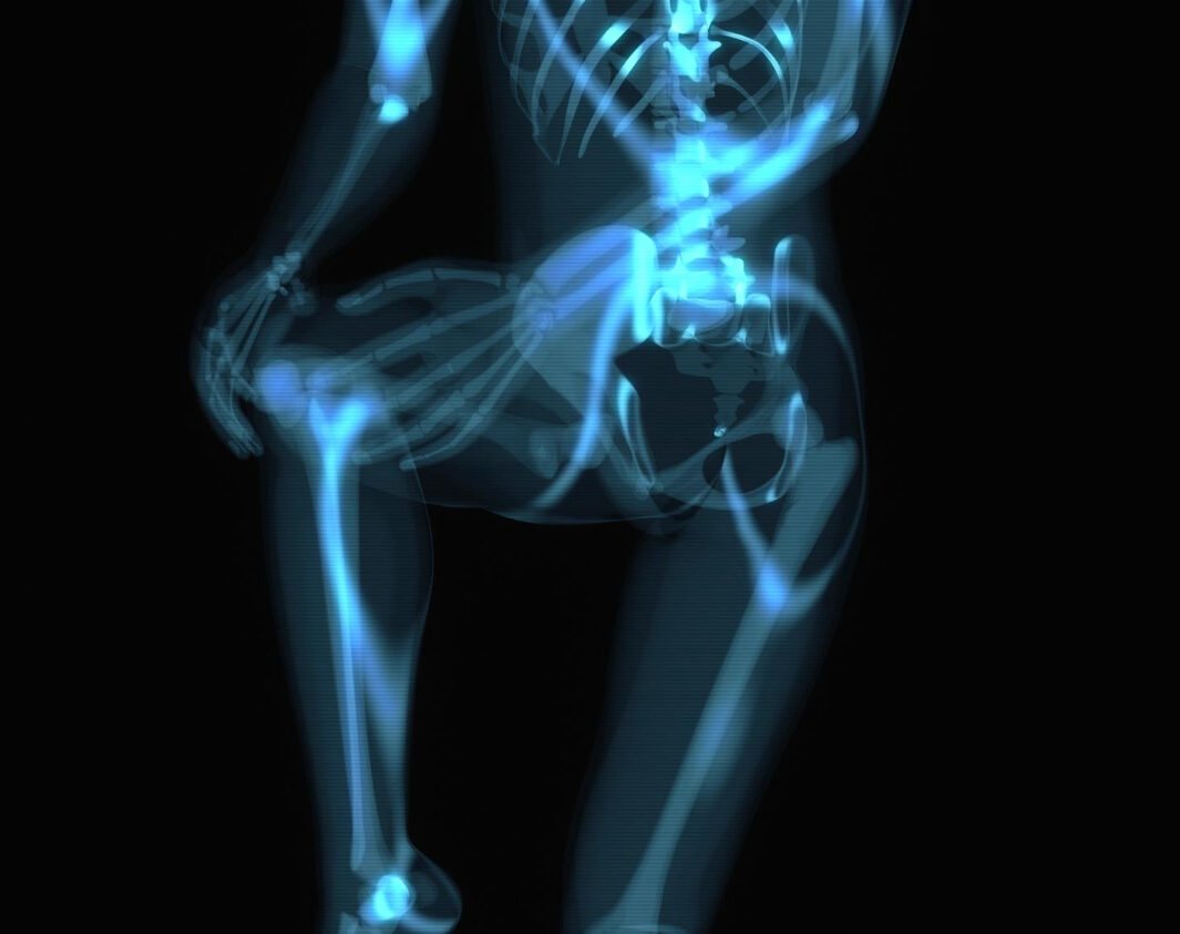 οστεοσύνθεση