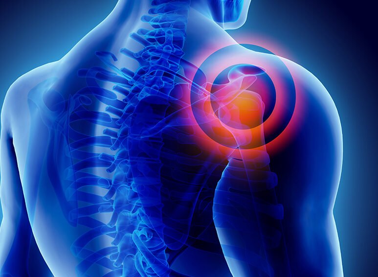 ανάστροφη ολική αρθροπλαστική ώμου