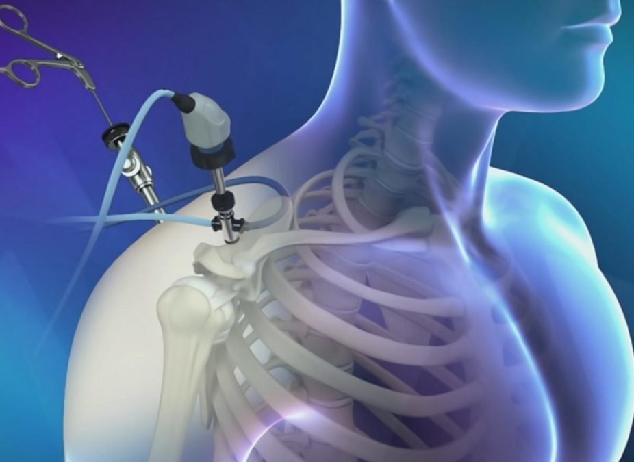 αρθροσκόπηση ώμου