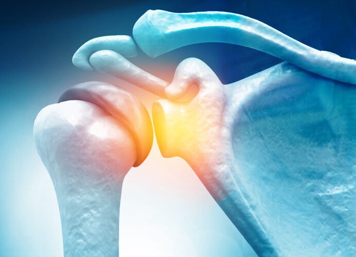 αρθροπλαστική ώμου