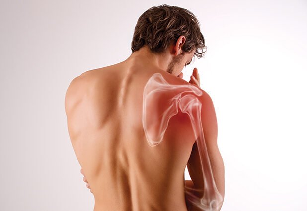 εξάρθρημα ώμου